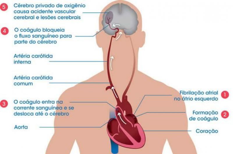  O acidente vascular cerebral (AVC) ou derrame