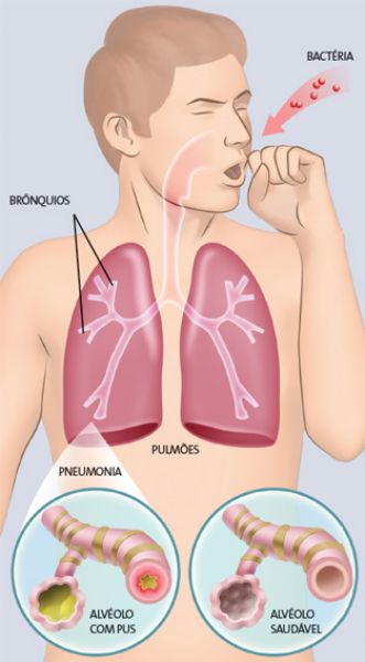  Entenda tudo sobre doenças pneumocócicas