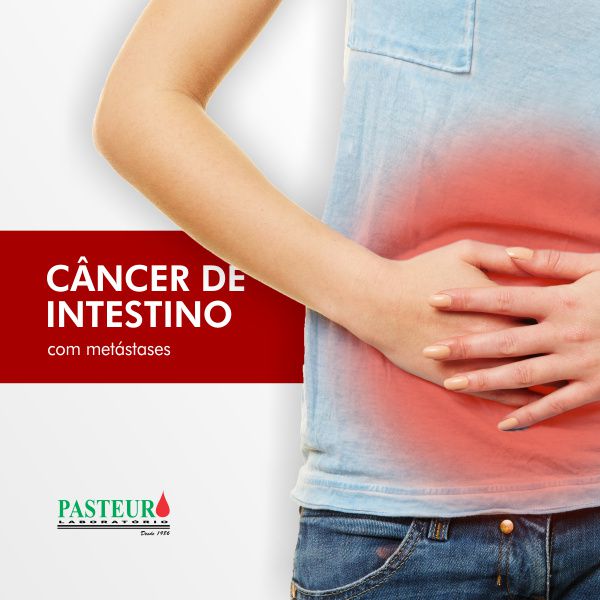  Câncer de intestino com metástases